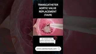 TAVR patient education from our website clinic.cardiovisual.com #cardiachealth#doctor#cardiacdisease