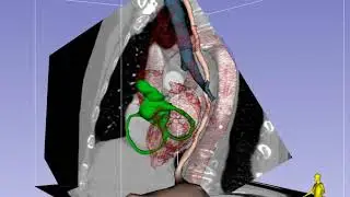 Mid-Esophageal Bicaval Imaging Plane in TEE - Standard View