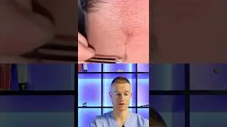 👁ОБНАРУЖЕН СКЛАД ПОД КОЖЕЙ - удаление вросших волос 