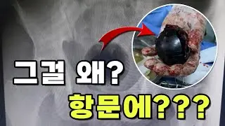 세계이슈ㅣ치질 치료를 하기 위해 아내와 항문에 넣었습니다