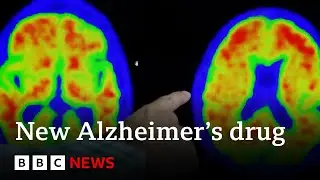 New drug brings hope to end Alzheimers - BBC News