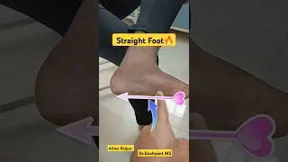 Live 🔥 Flat Foot | सपाट पैर | Straight Foot | 