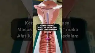 CARA MEMASUKAN KB IUD KEDALAM RAHIM!! | KB SPIRAL DALAM RAHIM! 