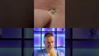 🌚СЮРПРИЗ ПОД КОЖЕЙ - чистка лица от комедонов и прыщей 