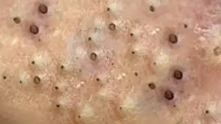 Blackheads & Whiteheads Satisfying Removal @0183