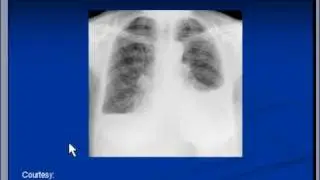 Chest x-ray -- Pleural effusion, Pneumonia