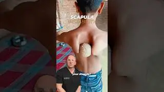 Can Shoulder Blades Be TOO Flexible? #shorts