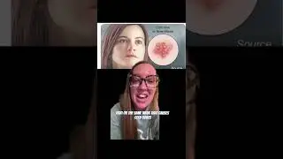 Herpes in the brain? Learn about herpes encephalitis w/ Dr. Grunch -full vid in comments 