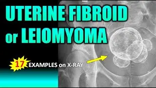 Uterine Fibroid or Leiomyoma 