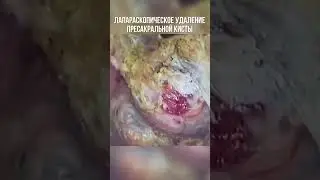 Лапароскопическая операция по удалению кисты | больше о здоровье на канале #медицинскийканал