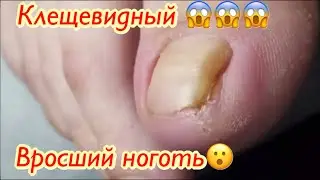 Клещевидный 😱😱😱 вросший ноготь