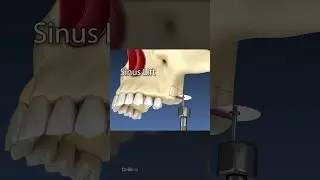 Sinus Lift Surgery: 3D Animation