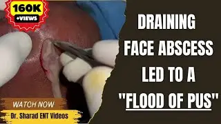 DRAINING FACE ABSCESS LED TO A FLOOD OF PUS | Dental Infection & Complication | Patient's Nightmare