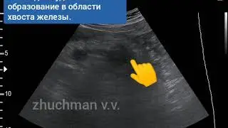 УЗИ рак поджелудочной железы