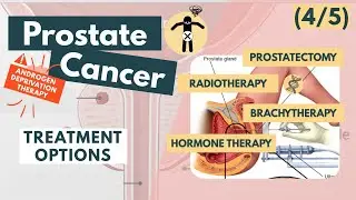 Treatment of prostate cancer | Overview for Med Students | Urology