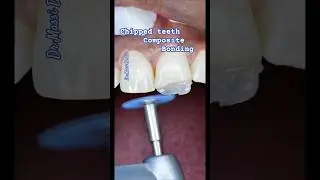 Chipped front Tooth, Composite Bonding