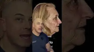 Doctor explains the astonishing results from a Phenol peel! 