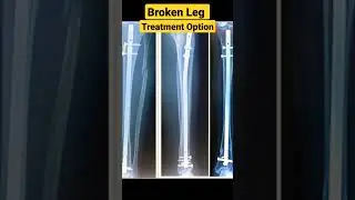 Broken Leg Treatment Options ✓✓