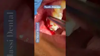 TOOTH ABSCESS