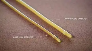 What Is a Suprapubic Catheter?