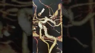 Мешотчатая аневризма СМА 3D реконструкция.