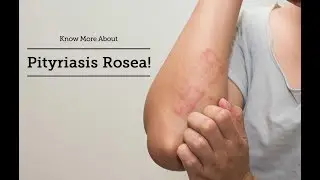 Pityriasis Rosea