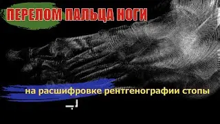 ОСТЕОПОРОЗ стопы, ПЕРЕЛОМ ПАЛЬЦА ноги и АРТРОЗ стопы на РАСШИФРОВКЕ рентгеновских снимков (2 мнение)