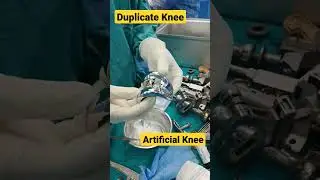 Total Knee Replacement ✓ | 