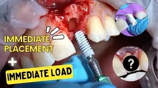 Immediate Implant Placement and Temporization