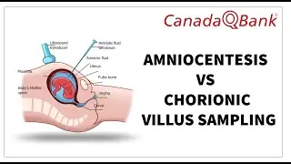 Amniocentesis vs Chorionic Villus Sampling