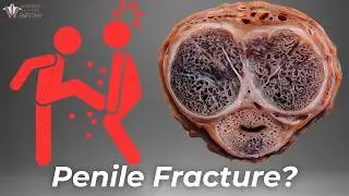 The Fracture You Don't Want - Penile Fractures