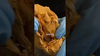 Crazy Things Found In Dead Bodies