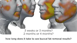 BUCCAL FAT REMOVAL | how long until I see my final result? REAL Surgery Results in 3D over time