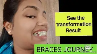 BRACES JOURNEY - See the transformation #braces #metalbraces #transformation #bracesjourney