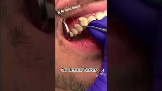 Dental Calculus or dental Tartar, dental Cleaning 