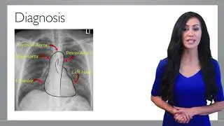 Tuberculosis - TB part 2