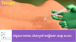 SPINAL & EPIDURAL ANAESTHESIA | Telugu