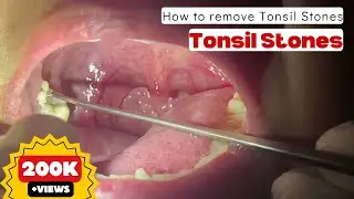 How to remove Tonsil Stones || Immediate Relief after TONSIL STONE Removal