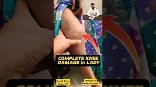 4th Stage Knee Arthritis 🔥