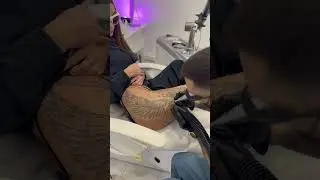 Удаление татуировки лазером в Москве  