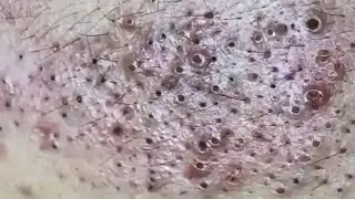 Blackheads & Whiteheads Satisfying Removal @0274