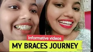 MY BRACES JOURNEY/ MY BRACES TRANSFORMATION VIDEO/ 15 Month #braces #ytshorts #trending #viral