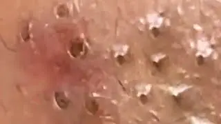 Blackheads & Whiteheads Satisfying Removal @0189