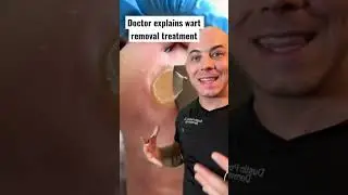 Doctor explains wart removal treatment! 