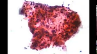 mesothelioma veterans