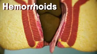 Hemorrhoids|different types of hemorrhoids| internal and external Hemorrhoids| Hemorrhoids treatment