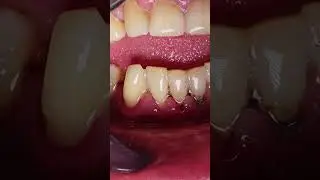 Satisfying TARTAR REMOVAL and CLEANING video