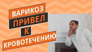 Опасное осложнение варикоза. Могла умереть от кровотечения. Флеболог Москва.