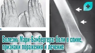Болезнь Мари-Бамбергера: боли в спине, признаки поражения и лечение