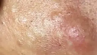 Blackheads & Whiteheads Satisfying Removal @0149